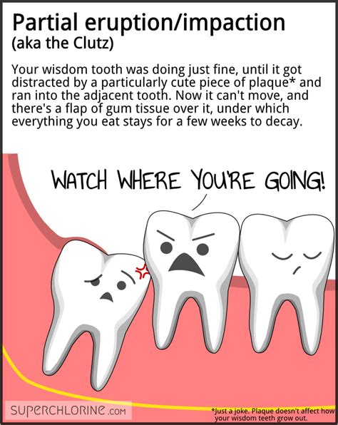 Partial Eruptionimpaction Aka The Clutz Your Wisdom Tooth Was Doing