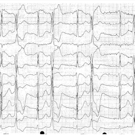 Twelve Lead Electrocardiogram Obtained During Ergometry Showing A