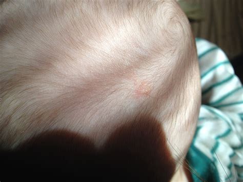 My 5 Month Old May Have Ringworm Of The Scalp Are Oral Medications