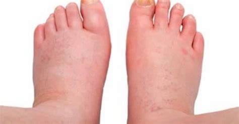 11 Major Causes Of Swollen Feet Artofit