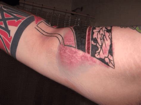 Infected Tattoo Stages Signs Of Infection From Tattoos And After