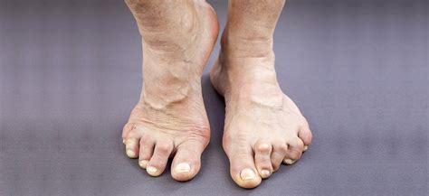 How Does Rheumatoid Arthritis Affect My Feet Footcare Scotland