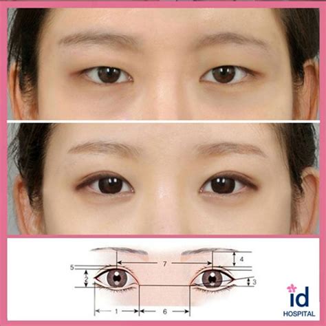 Create Double Eyelid That Will Suit Your Individual Facial Features