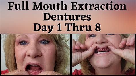 What To Expect With Immediate Dentures After Full Mouth Extraction
