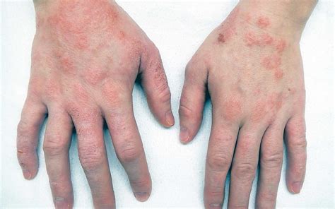 Combattere La Dermatite Atopica Cause E Sintomi Active Derma