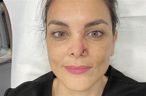 Carcinoma is the most common type of cancer and may occur in many parts of the body. Carcinoma basocelular: qué es, síntomas y diagnóstico | Salud