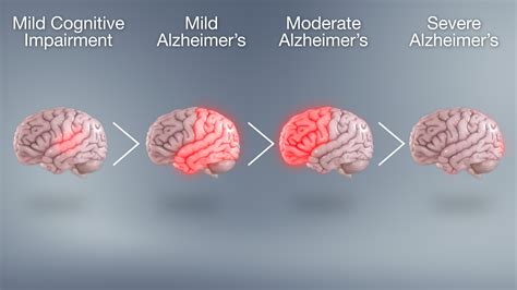 Progression Of Alzheimers Disease Scientific Animations