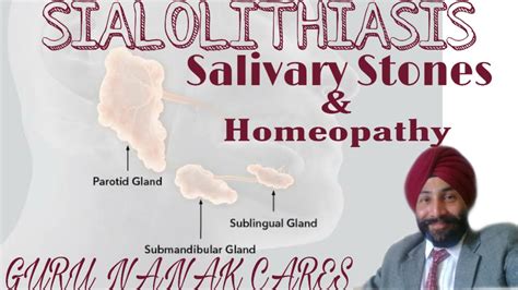 लार ग्रंथि में पथरी Sialolithiasis Salivary Gland Stones And Their