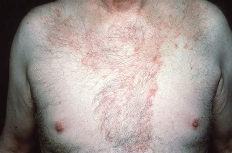 Diagnosis And Treatment Of Seborrheic Dermatitis Da7
