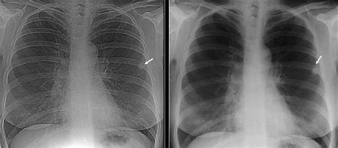A 694 systematic review and. Calcified granuloma definition, causes, symptoms ...