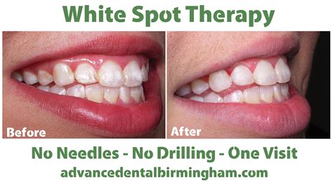 How to get rid of white spots on teeth after braces. What are white spots on teeth and what can you do about ...