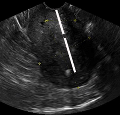 Anteverted Retroflexed Uterus A Common Consequence Of Cesarean