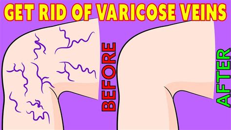 How To Get Rid Of Varicose Veins Naturally In 3 Minutes A Day Youtube