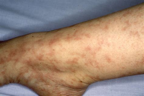 Mottled Skin Livedo Recticularis Causes Symptoms And Pictures