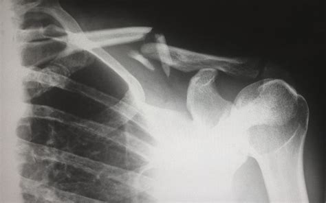 Clavicle Fracture Collar Bone