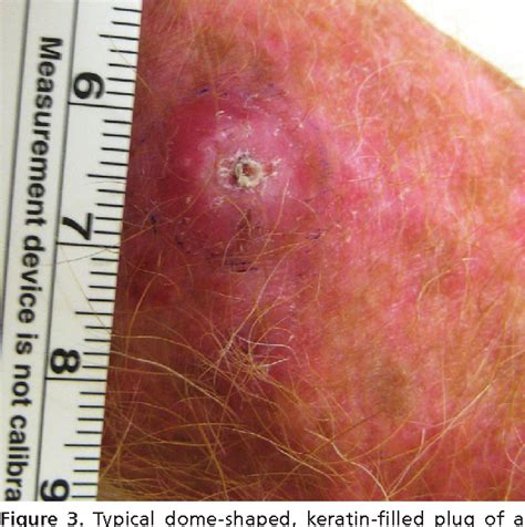 Figure 3 From Diagnosing Common Benign Skin Tumors Semantic Scholar