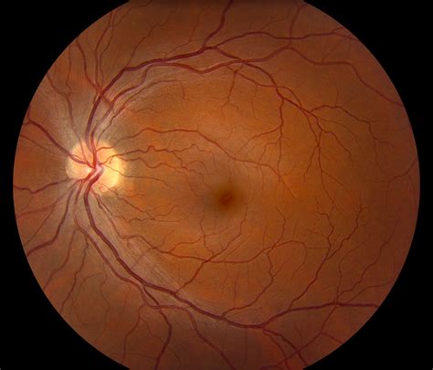 About Diabetic Retinopathy Carver College Of Medicine