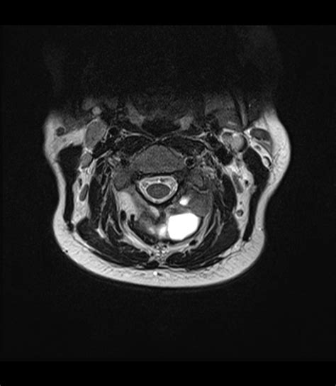 Aneurysmal Bone Cyst Cervical Spine Image Radiopaedia Org