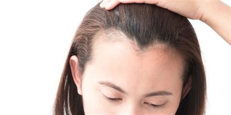 Receding Hairline Reasons Signs Treatment And Every Thing Human