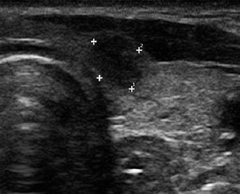 Hypoechoic Nodule At The Junction Of The Left Thyroid Lobe And Isthmus