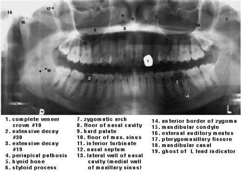 Both intraoral and extraoral dental radiographs are often needed to assess the subgingival status of the affected tooth and to guide the practitioner through the endodontic treatment. Normal Panoramic Anatomy. Dental Anatomy and Tooth ...