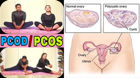 Cure Pcod Pcos Pcod Yoga Exercises Yoga For Pcod Yoga For Pcos Pcod Pcos Workout Youtube