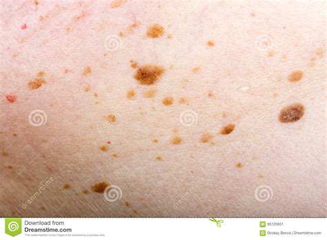 Many Nevus On Human Skin Stock Image Image Of Macro 85120931
