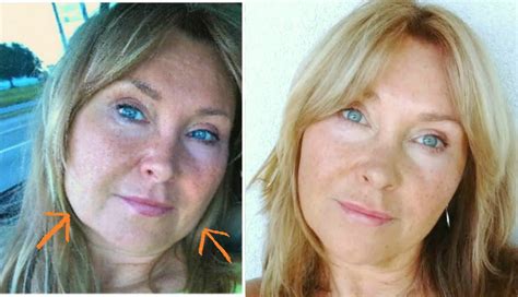 Sagging Face Diy Facelift Without Surgery