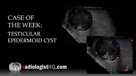 Case Of The Week Testicular Epidermoid Cyst Ultrasound Youtube