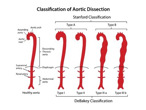 dilated aortic root associated with higher rates of aortic dissection at a smaller diameter