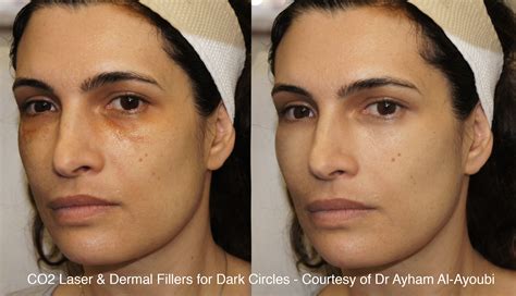 Co2 Laser Skin Resurfacing London Before And After Pics Uks Best Clinic
