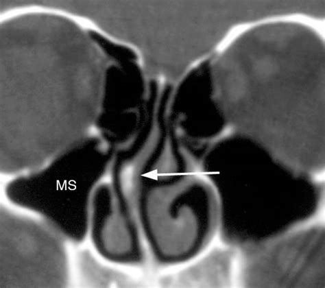 Ct scans have many benefits that outweigh any small potential risk. Deviated Septum Cocaine Abuse
