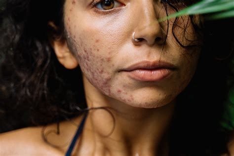 How To Tell If You Have Hormonal Acne Nicole Williams Collective