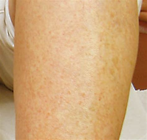 List 91 Pictures Pictures Of Skin Rashes On Arms Completed 102023