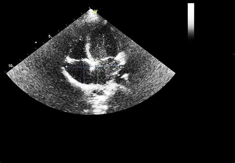 Screen Of Echocardiography Ultrasound Machine Stock Image Image Of