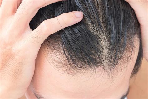 Thinning Hair A Surprising Common Cause Of Thinning Hair Readers Digest