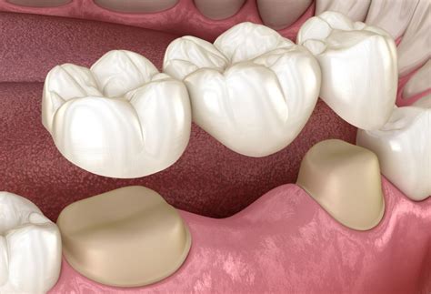 Dental Bridge 4 Types Benefits Use Case And Costs TMJ And Sleep