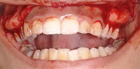 Exostosis Dental