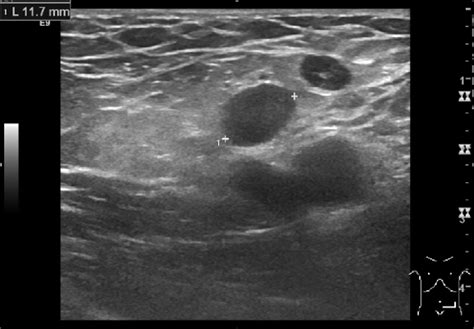 Groin Lymph Nodes Ultrasound