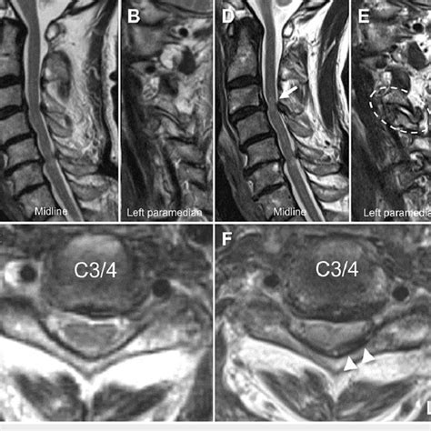Preoperative Cervical Computed Tomography Images A Midline Sagittal
