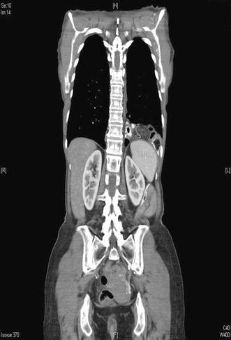 Check spelling or type a new query. Incidence of diaphragmatic hernias following minimally ...