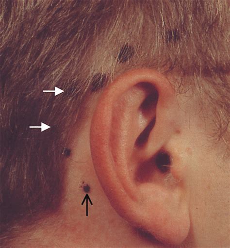 Swollen Lymph Nodes Behind Ear Pictures To Pin On Pinterest Pinsdaddy