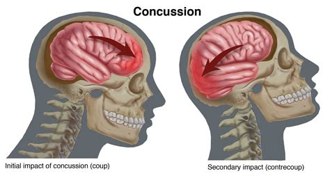 Anatomy Concussions Physical Therapy Post Concussion Syndrome