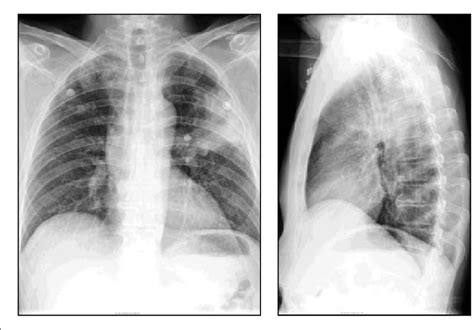 Left Upper Lobe Pneumonia Lobar Pneumonia Seen On Chest X Ray Results