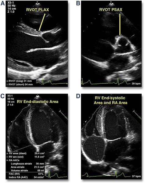 Echocardiographic Assessment Of Right Ventricular Function By Two