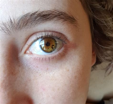 Everything You Need To Know About Eye Freckles From Harmless To