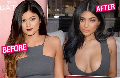 Total Transformation See The Eye Popping Evolution Of Kylie Jenners Boobs