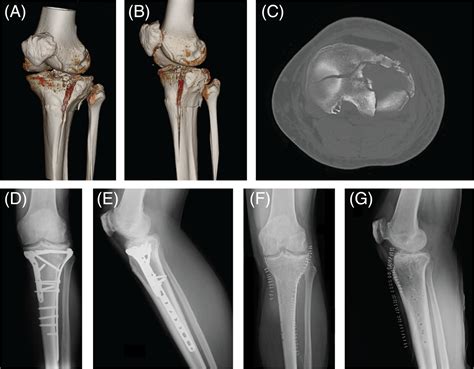 Challenging Surgical Treatment Of Displaced Articular Tibial Plateau