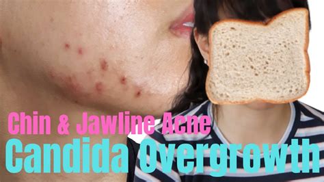 Candida Overgrowth Causes Acne In Chinjawline Pohchooo Youtube