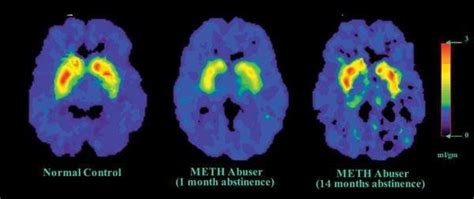 Meth Brain Harm Cut By Medicinova Drug The San Diego Union Tribune
